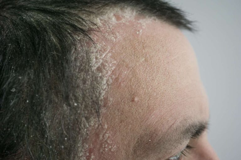 About The Hair Psoriasis – Causes, Symptoms And Cure